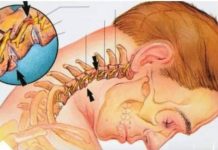 UKLONITE NAKUPINE SOLI NA VRATU: Kako sam izliječila osteohondrozu bez skupih lijekova