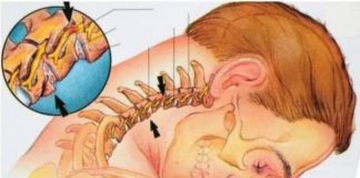 UKLONITE NAKUPINE SOLI NA VRATU: Kako sam izliječila osteohondrozu bez skupih lijekova