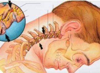 UKLONITE NAKUPINE SOLI NA VRATU: Kako sam izliječila osteohondrozu bez skupih lijekova