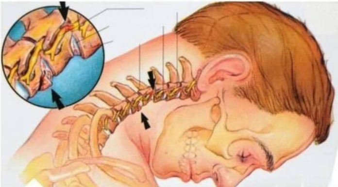 UKLONITE NAKUPINE SOLI NA VRATU: Kako sam izliječila osteohondrozu bez skupih lijekova