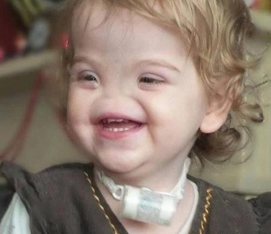 Rođena bez nosa, ali s nevjerovatnom snagom: Inspirativna životna priča djevojčice koja je pobijedila predrasude