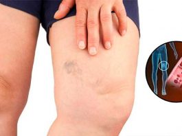 Simptomi krvnih ugrušaka u tijelu: Ako to primijetite, odmah potražite medicinsku pomoć