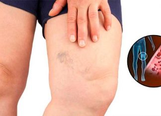 Simptomi krvnih ugrušaka u tijelu: Ako to primijetite, odmah potražite medicinsku pomoć