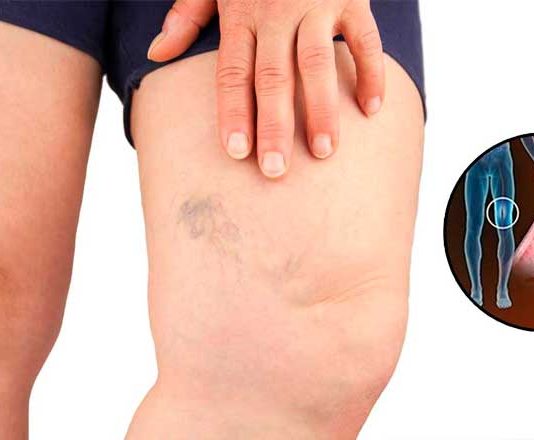 Simptomi krvnih ugrušaka u tijelu: Ako to primijetite, odmah potražite medicinsku pomoć