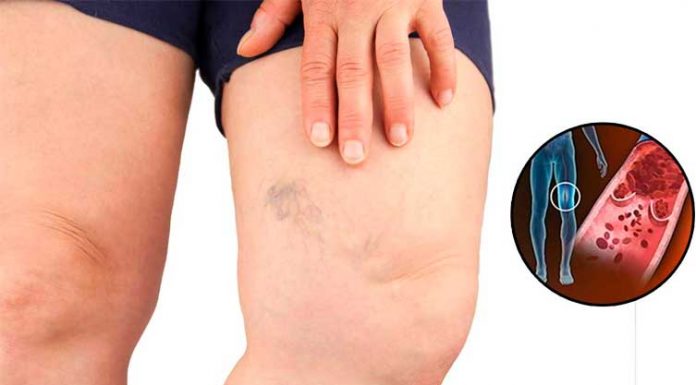 Simptomi krvnih ugrušaka u tijelu: Ako to primijetite, odmah potražite medicinsku pomoć