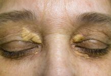 STAVILA SAM OVU NAMIRNICU NA MASNO TKIVO KOD OKA, ono je preko noći nestalo: EVO ŠTA ME SPASILO, SVI GA IMATE U KUĆI