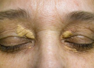 STAVILA SAM OVU NAMIRNICU NA MASNO TKIVO KOD OKA, ono je preko noći nestalo: EVO ŠTA ME SPASILO, SVI GA IMATE U KUĆI