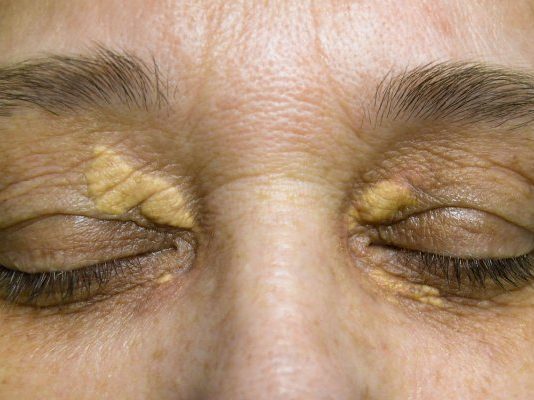 STAVILA SAM OVU NAMIRNICU NA MASNO TKIVO KOD OKA, ono je preko noći nestalo: EVO ŠTA ME SPASILO, SVI GA IMATE U KUĆI