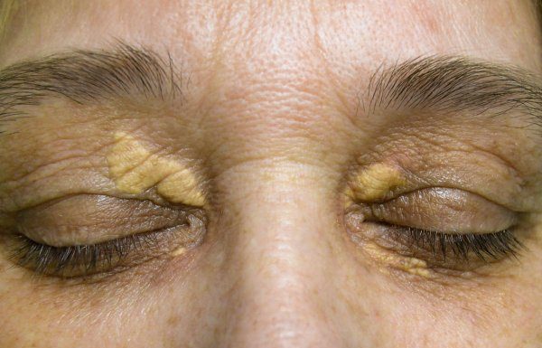 STAVILA SAM OVU NAMIRNICU NA MASNO TKIVO KOD OKA, ono je preko noći nestalo: EVO ŠTA ME SPASILO, SVI GA IMATE U KUĆI