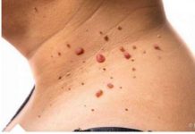 Kažite ZBOGOM PAPILOMIMA U SAMO 1. POTEZU: Ovu namirnicu imate kod kuće, PREPORUČUJU JE I DOKTORI