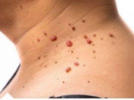 Kažite ZBOGOM PAPILOMIMA U SAMO 1. POTEZU: Ovu namirnicu imate kod kuće, PREPORUČUJU JE I DOKTORI