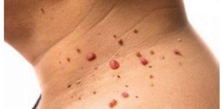 Kažite ZBOGOM PAPILOMIMA U SAMO 1. POTEZU: Ovu namirnicu imate kod kuće, PREPORUČUJU JE I DOKTORI