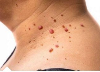 Kažite ZBOGOM PAPILOMIMA U SAMO 1. POTEZU: Ovu namirnicu imate kod kuće, PREPORUČUJU JE I DOKTORI