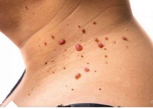 Kažite ZBOGOM PAPILOMIMA U SAMO 1. POTEZU: Ovu namirnicu imate kod kuće, PREPORUČUJU JE I DOKTORI