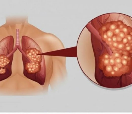 PUŠAČI, PAŽNJA! Za 3 dana izbacite sve otrove iz tijela: Ova metoda skida OTROV SA ZIDOVA PLUĆA, sprečava rak, izbacuje masnoće i višak vode!