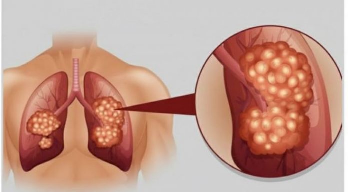 PUŠAČI, PAŽNJA! Za 3 dana izbacite sve otrove iz tijela: Ova metoda skida OTROV SA ZIDOVA PLUĆA, sprečava rak, izbacuje masnoće i višak vode!