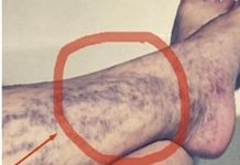 Svako ima ovaj lijek za ispucale kapilare kod kuće, ali mnogi ljudi ne znaju za njega!