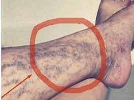 Svako ima ovaj lijek za ispucale kapilare kod kuće, ali mnogi ljudi ne znaju za njega!