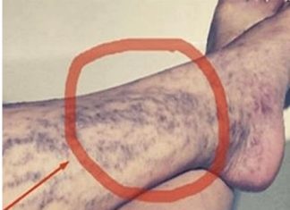 Svako ima ovaj lijek za ispucale kapilare kod kuće, ali mnogi ljudi ne znaju za njega!