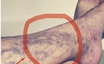 Svako ima ovaj lijek za ispucale kapilare kod kuće, ali mnogi ljudi ne znaju za njega!