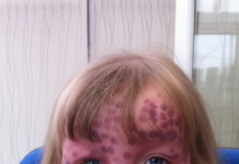 Devojčica se rodila sa retkom mrljom….