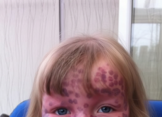 Devojčica se rodila sa retkom mrljom….