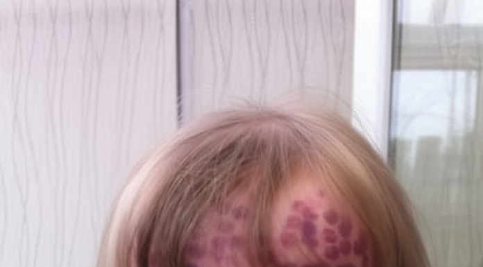 Devojčica se rodila sa retkom mrljom….