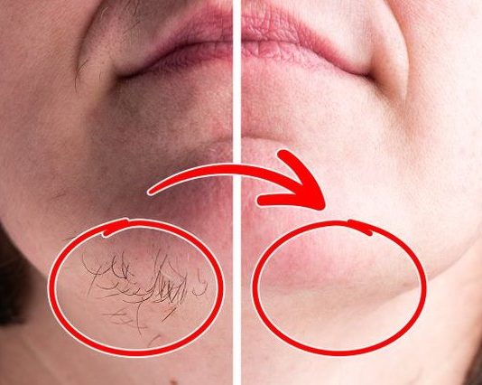 SVAKA ŽENA ZASLUŽUJE DA OVO ZNA: Prirodnim putem uklonite brkove i druge neželjene dlačice sa tijela zauvijek