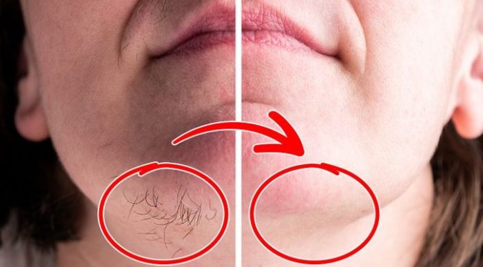 SVAKA ŽENA ZASLUŽUJE DA OVO ZNA: Prirodnim putem uklonite brkove i druge neželjene dlačice sa tijela zauvijek