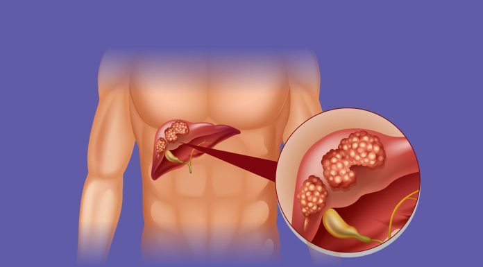 Prvi simptom r*ka jetre javlja se dok jedete – Mnogi ga zanemaruju, a znakovi su očigledni