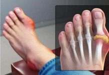 IZBACITE MOKRAĆNU KISELINU IZ TIJELA, IZBACITE GIHT: 3 Narodna Lijeka Koja Provjereno Djeluju, OVO ĆE VAM POMOĆI! (RECEPT)