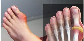 IZBACITE MOKRAĆNU KISELINU IZ TIJELA, IZBACITE GIHT: 3 Narodna Lijeka Koja Provjereno Djeluju, OVO ĆE VAM POMOĆI! (RECEPT)