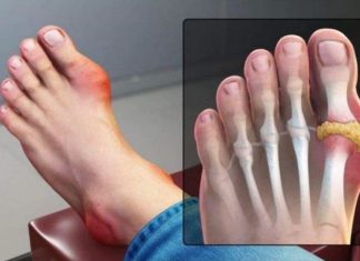 IZBACITE MOKRAĆNU KISELINU IZ TIJELA, IZBACITE GIHT: 3 Narodna Lijeka Koja Provjereno Djeluju, OVO ĆE VAM POMOĆI! (RECEPT)