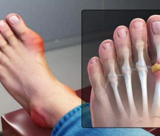 IZBACITE MOKRAĆNU KISELINU IZ TIJELA, IZBACITE GIHT: 3 Narodna Lijeka Koja Provjereno Djeluju, OVO ĆE VAM POMOĆI! (RECEPT)