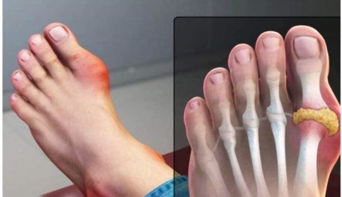 IZBACITE MOKRAĆNU KISELINU IZ TIJELA, IZBACITE GIHT: 3 Narodna Lijeka Koja Provjereno Djeluju, OVO ĆE VAM POMOĆI! (RECEPT)