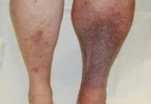 RUSKI RECEPT KOJI RASTVARA TROMB