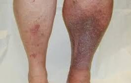 RUSKI RECEPT KOJI RASTVARA TROMB