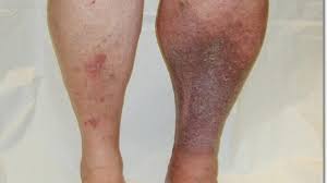 RUSKI RECEPT KOJI RASTVARA TROMB