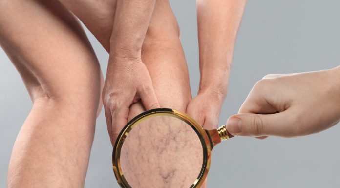 Zašto Su Vam Vene Odjednom Vidljivije? Uzroci, Savjeti i Kada Potražiti Pomoć