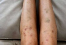 Pojavile Su Vam Se Modrice Na Tijelu Bez Razloga: EVO ŠTA ONE MOGU ZNAČITI,NE IGNORIŠITE!!!