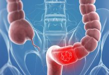 Tihi signali opake bolesti: Ovo su 4 znaka raka debelog crijeva koje tijelo šalje mjesecima prije