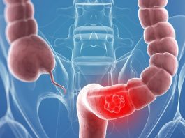 Tihi signali opake bolesti: Ovo su 4 znaka raka debelog crijeva koje tijelo šalje mjesecima prije