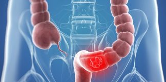 Tihi signali opake bolesti: Ovo su 4 znaka raka debelog crijeva koje tijelo šalje mjesecima prije