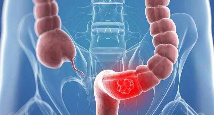 Tihi signali opake bolesti: Ovo su 4 znaka raka debelog crijeva koje tijelo šalje mjesecima prije