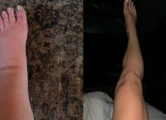 Upute kako da IZBACI VIŠAK VODE IZ TELA: Vaša stopala će prestati da otiču kada to uradite!