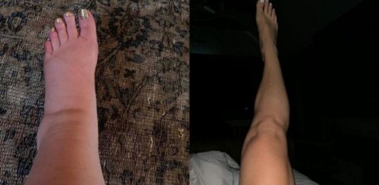 Upute kako da IZBACI VIŠAK VODE IZ TELA: Vaša stopala će prestati da otiču kada to uradite!