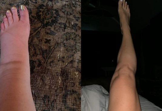 Upute kako da IZBACI VIŠAK VODE IZ TELA: Vaša stopala će prestati da otiču kada to uradite!