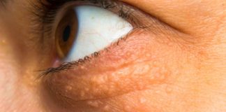 STAVILA SAM OVU NAMIRNICU NA MASNO TKIVO KOD OKA, ono je preko noći nestalo: EVO ŠTA ME SPASILO, SVI GA IMATE U KUĆI