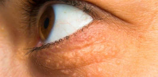 STAVILA SAM OVU NAMIRNICU NA MASNO TKIVO KOD OKA, ono je preko noći nestalo: EVO ŠTA ME SPASILO, SVI GA IMATE U KUĆI