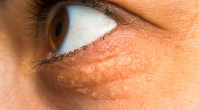 STAVILA SAM OVU NAMIRNICU NA MASNO TKIVO KOD OKA, ono je preko noći nestalo: EVO ŠTA ME SPASILO, SVI GA IMATE U KUĆI